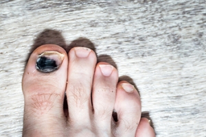 Painful Runner&#039;s Toe