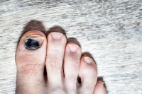 Painful Runner's Toe