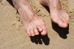 Description of Hammertoe