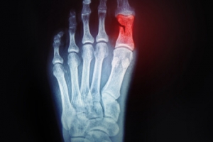 Taking Care of a Broken Toe