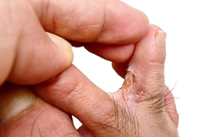 Athlete&#039;s Foot Is a Common Fungal Infection