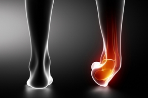 How to Manage Ankle Sprains