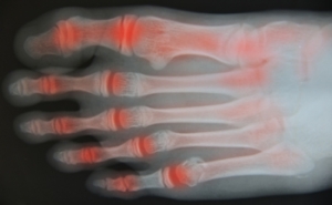Noticing the First Signs of Arthritis in Your Feet