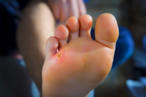Definition and Symptoms of Corns