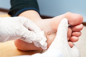 Symptoms and Risks of Plantar Warts
