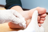 Symptoms and Risks of Plantar Warts