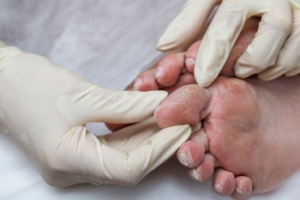 What to Know About the Diabetic Foot