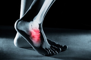 Foot Stress Fractures and Sports That Cause Them