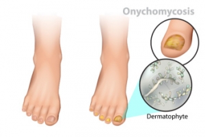 Understanding Toenail Fungal Infections in Children