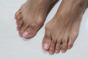 What Are Bunions?