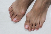 What Are Bunions?