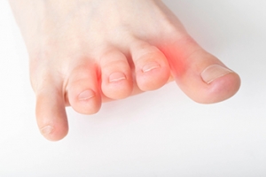 Causes and Relief of Foot Neuromas